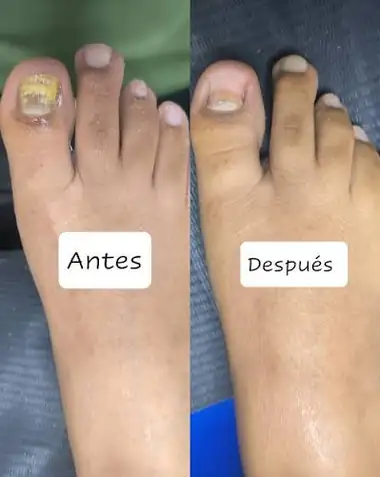 Uña del dedo gordo con hongos antes del tratamiento y la misma uña sana después