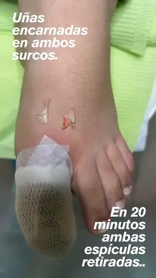 Dedo gordo con curación después de retirar las espículas de una uña encarnada en ambos lados, con las dos espículas retiradas al lado