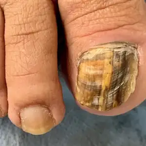 Uña del dedo gordo engrosada y amarilla por hongos